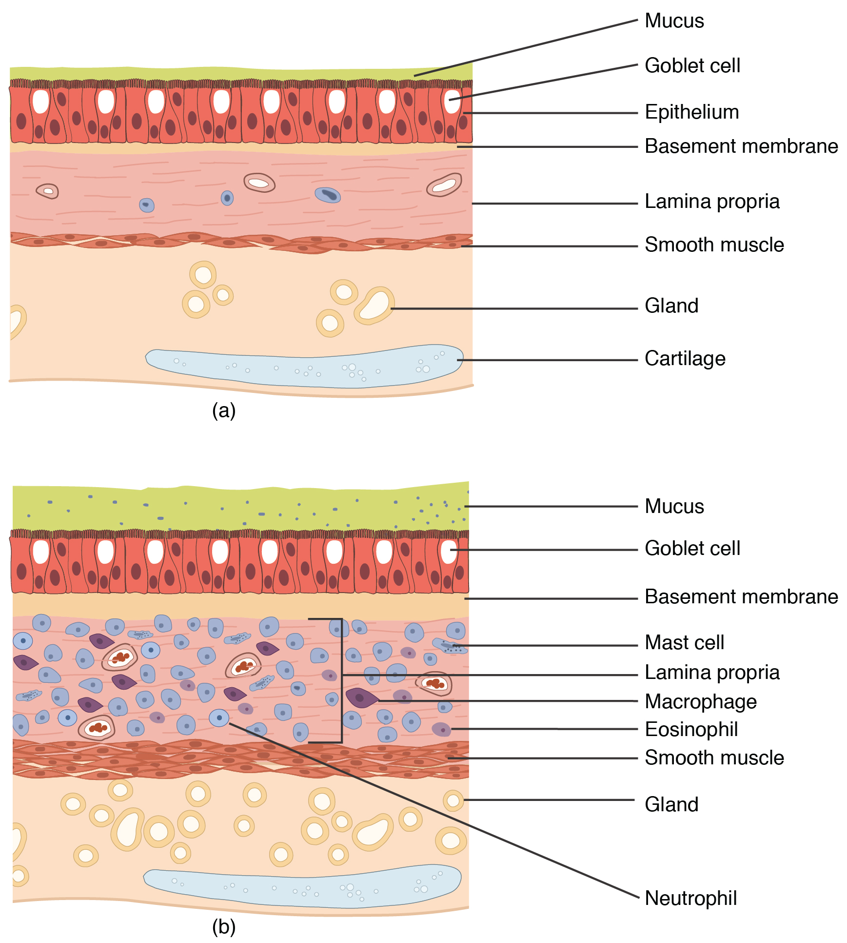 (a) Normal lung tissue does not have the characteristics of lung tissue during (b) an asthma attack, which include thickened mucosa, increased mucus-producing goblet cells, and eosinophil infiltrates. The top panel of this figure shows normal lung tissue, and the bottom panel shows lung tissue inflamed by asthma.